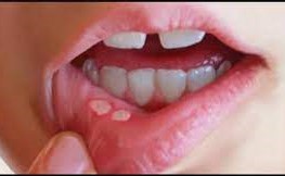 كيفية علاج تقرحات الفم