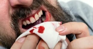 سبب خروج الدم من الفم