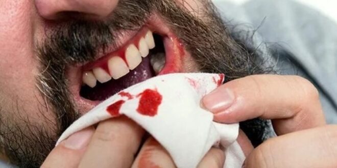 سبب خروج الدم من الفم
